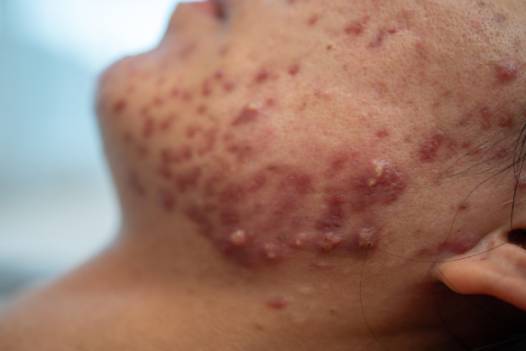 acne-on-face-because-the-disorders-of-sebaceous