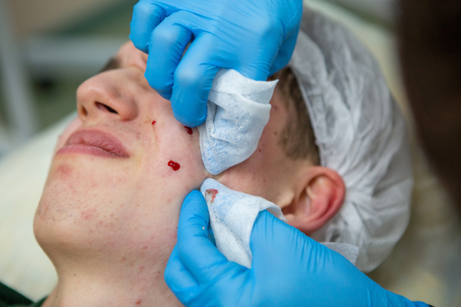 acne-treatment-in-a-teenager