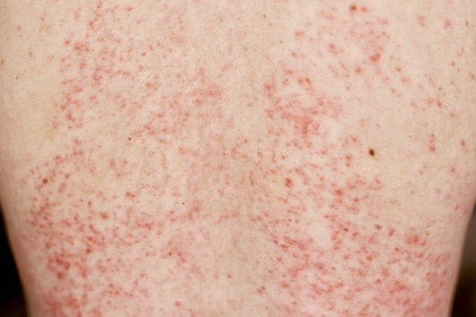 allergic-rash-on-skin-woman-with-dermatology