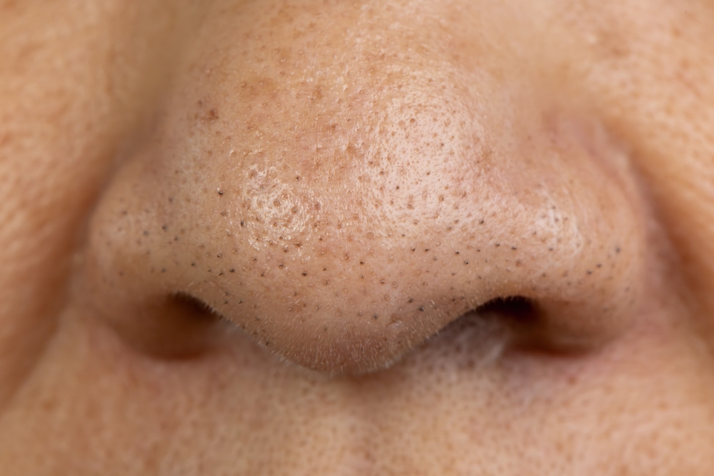 Senior,Woman,Worry,About,Enlarged,Pores,Skin,And,Blackhead,On