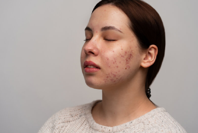 Facial Seborrhea (1)
