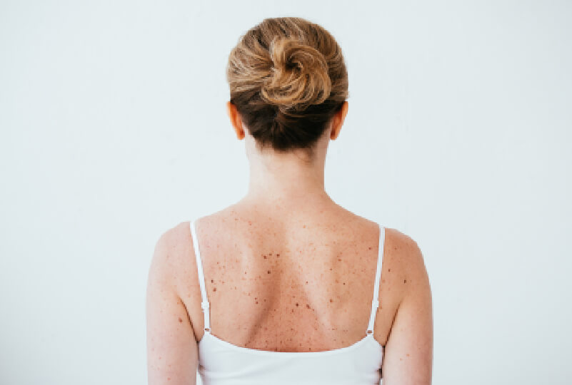 seborrheic eczema